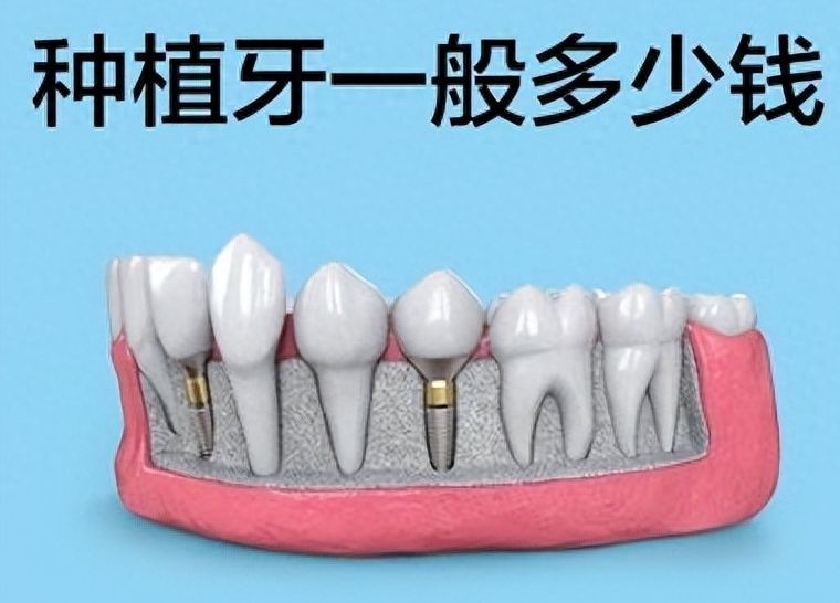 牙齒矯正為何需要支抗釘？費用幾何？