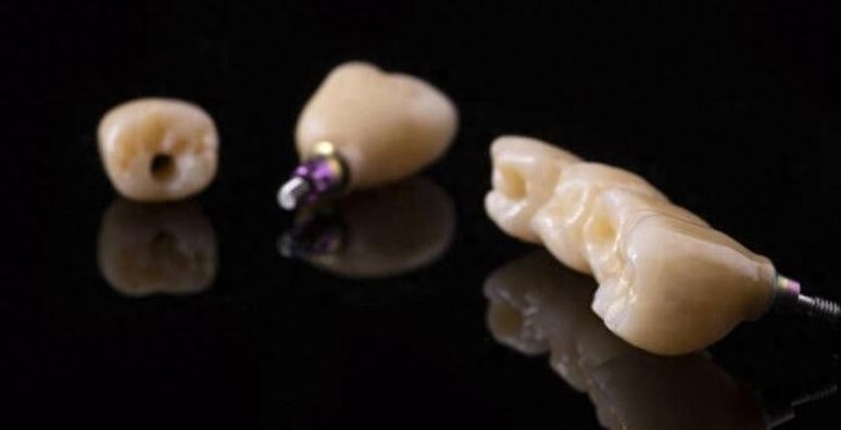 美奧口腔種植牙、牙齒矯正收費貴不貴？價格表告訴您