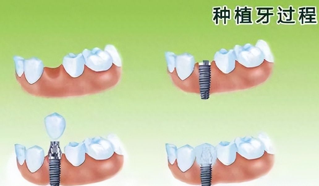 南陽種牙費(fèi)用及推薦醫(yī)生介紹