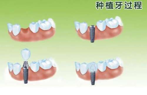 揭秘廣州中山三院種植牙：費(fèi)用、技術(shù)與專(zhuān)家詳解