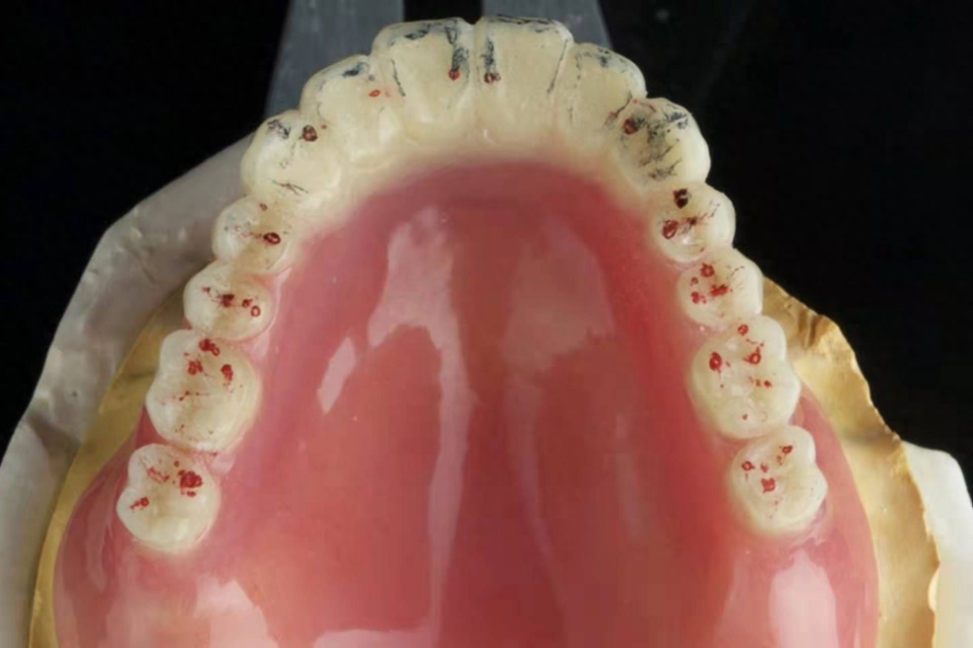 全口假牙多少錢？專家解讀價(jià)格差異，推薦性價(jià)比高的種植方案