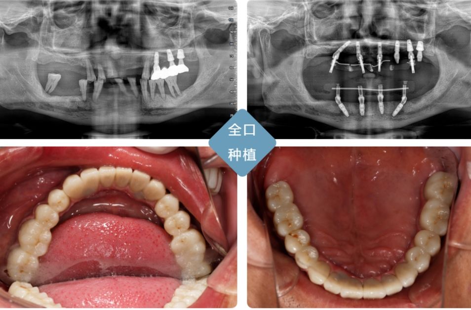 武俊杰口腔醫(yī)生網(wǎng)上掛號(hào)及種植牙費(fèi)用介紹