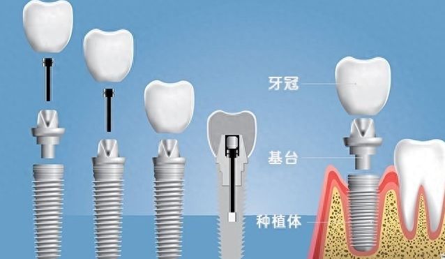 上海種植牙醫(yī)生權(quán)威榜單出爐，莫嘉驥、賴紅昌領(lǐng)銜TOP7